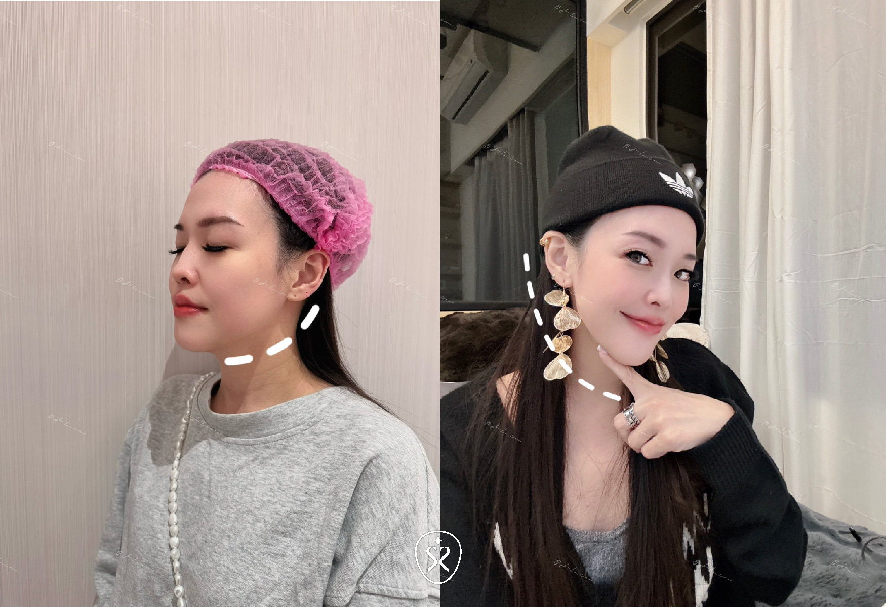 玩美電波隨著膠原蛋白新生重組漸進式的效果，看起來臉蛋及輪廓會愈來愈精緻